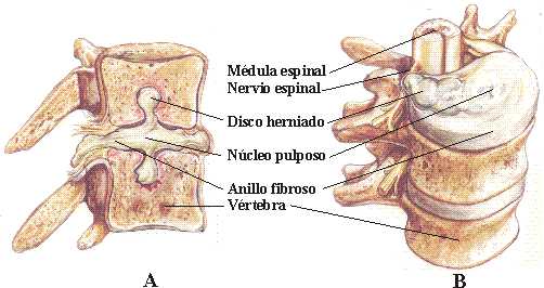 Discal Hernia