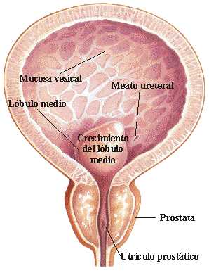 Cirugía de próstata y disfunción eréctil