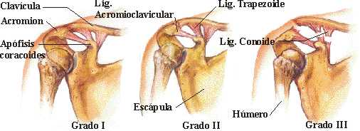 luxacion acromioclavicular